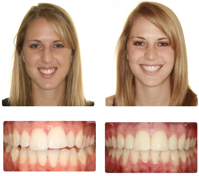 Before After Brace G1 Dental Practice Nhs Dentist Glasgow City